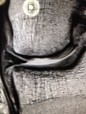 MRI OA in Knee
How to diagnose osteoarthritis