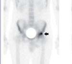 Bone scan of Avascular Necrosis of the Hip