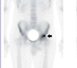 Bone scan of avascular necrosis of the hip