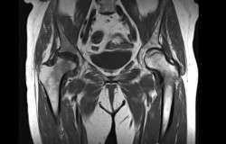 MRI Avascular Necrosis of Hip