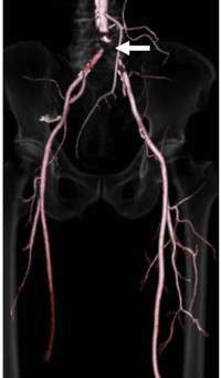 Critical Limb Ischemia